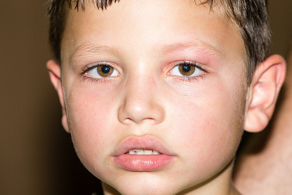 Bee Sting!